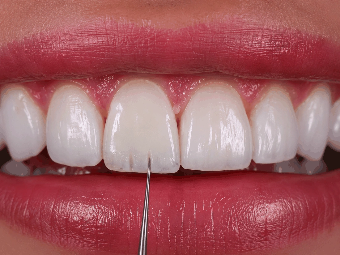Instrumento fino definindo a anatomia e os sulcos do dente, escultura à mão