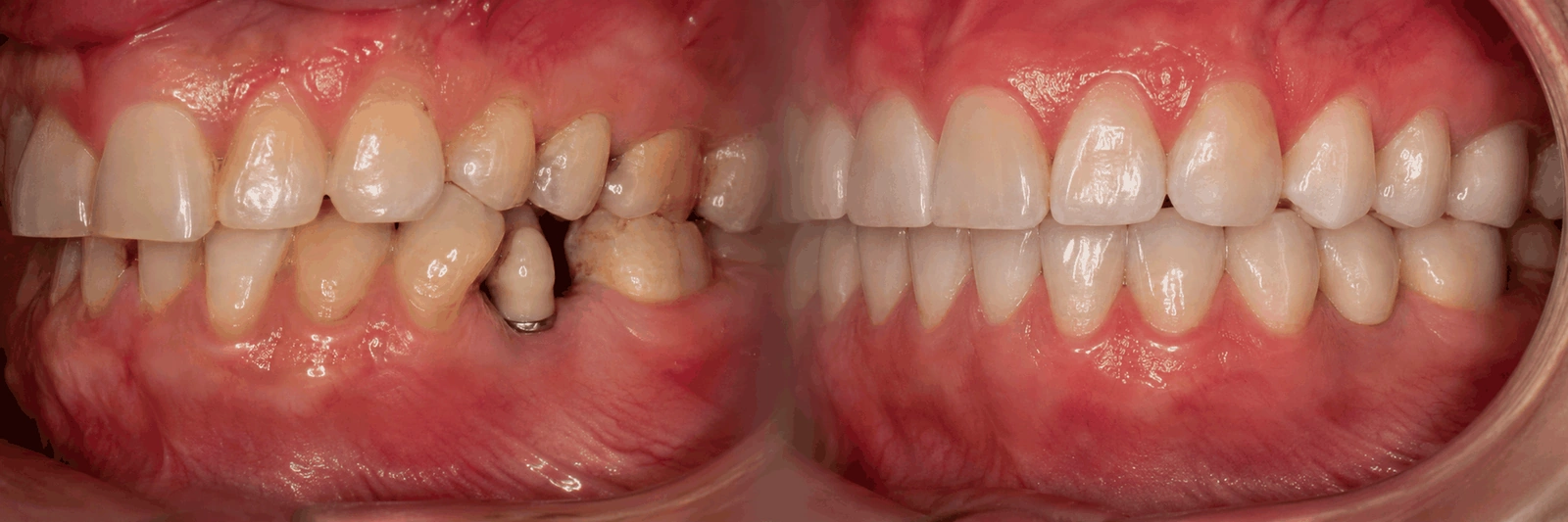 Comparação em visão lateral: à esquerda, dentes desalinhados com espaço insuficiente e implante mal posicionado; à direita, espaço correto e implante integrado à mordida