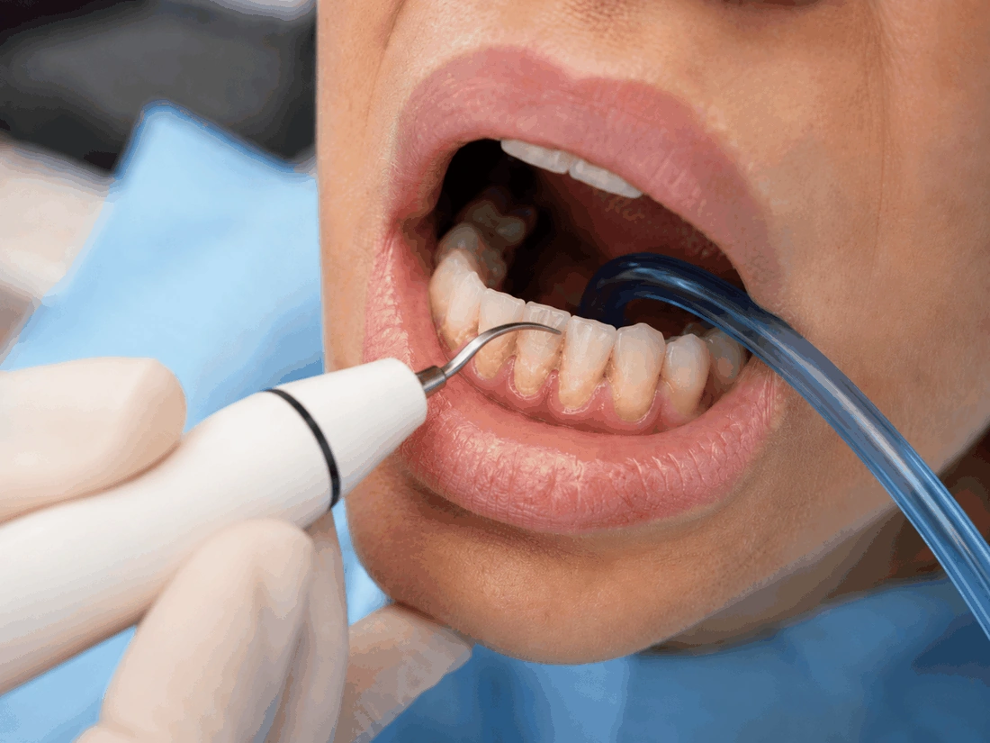 Limpeza em andamento com ultrassom e sugador, close do instrumental delicado